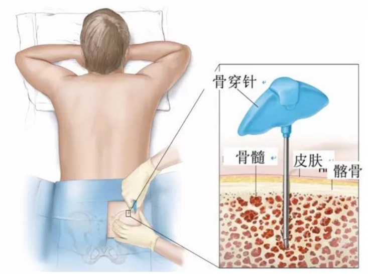 什么是骨髓针科普-关于骨髓穿刺你应该了解的那些事_https://www.jmylbn.com_新闻资讯_第3张