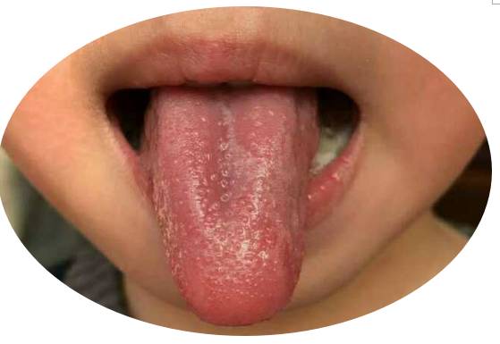 【教你看舌象知疾病】第15期:爱生气,反复咳嗽的地图舌
