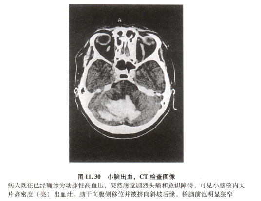 外展枕怎么使用中枢神经系统解剖定位诊断【大全】_https://www.jmylbn.com_新闻资讯_第147张