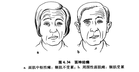 外展枕怎么使用中枢神经系统解剖定位诊断【大全】_https://www.jmylbn.com_新闻资讯_第75张