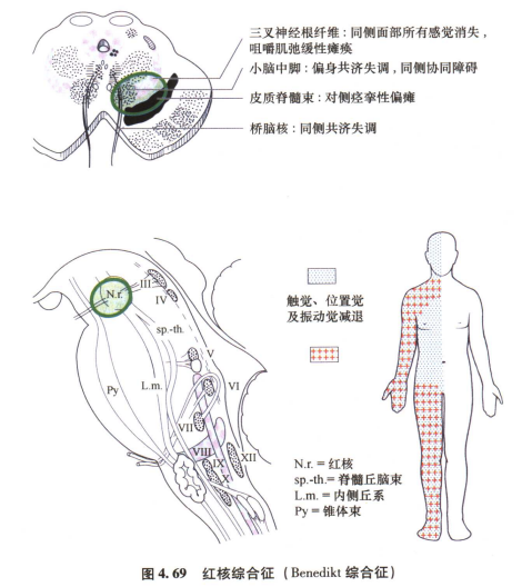 外展枕怎么使用中枢神经系统解剖定位诊断【大全】_https://www.jmylbn.com_新闻资讯_第126张