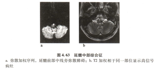 外展枕怎么使用中枢神经系统解剖定位诊断【大全】_https://www.jmylbn.com_新闻资讯_第120张
