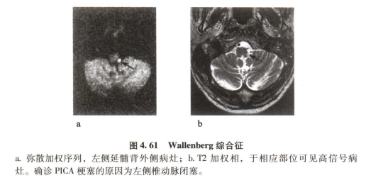 外展枕怎么使用中枢神经系统解剖定位诊断【大全】_https://www.jmylbn.com_新闻资讯_第118张
