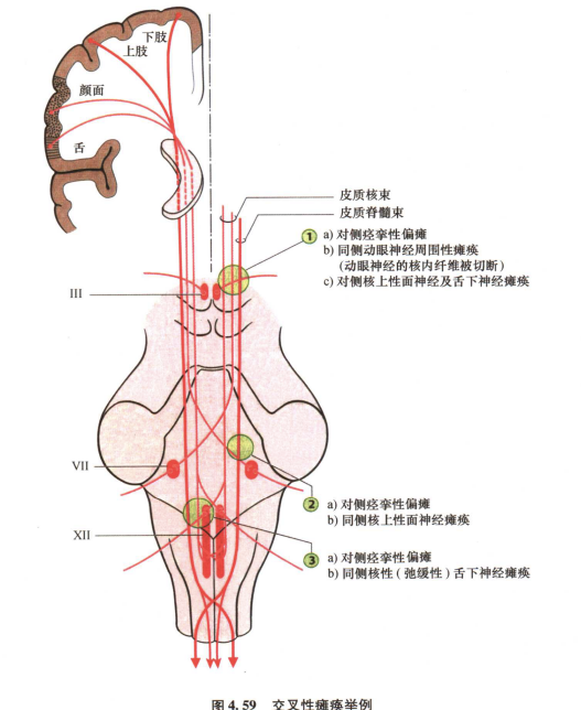 外展枕怎么使用中枢神经系统解剖定位诊断【大全】_https://www.jmylbn.com_新闻资讯_第116张
