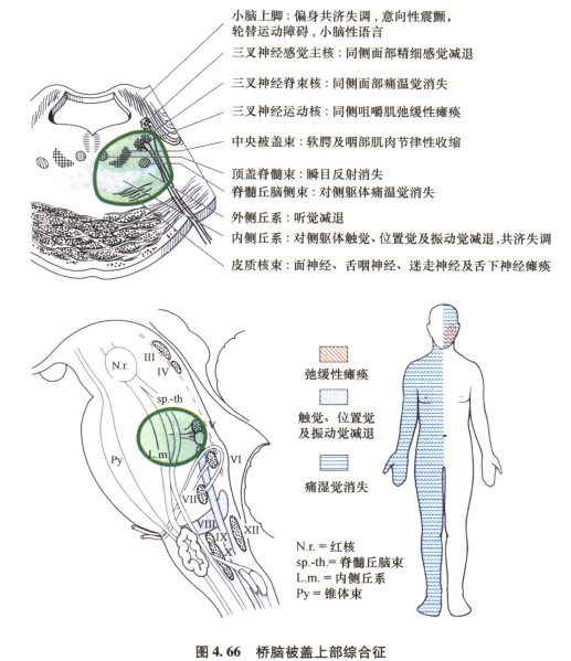 外展枕怎么使用中枢神经系统解剖定位诊断【大全】_https://www.jmylbn.com_新闻资讯_第123张