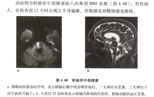 外展枕怎么使用中枢神经系统解剖定位诊断【大全】_https://www.jmylbn.com_新闻资讯_第125张