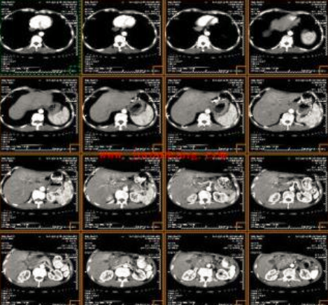 ct打印胶片怎么用远程就医、转院就医时，CT核磁DICOM电子胶片的重要性！【就医知识】_https://www.jmylbn.com_新闻资讯_第3张