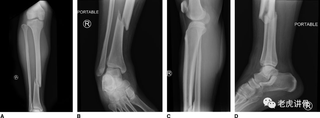 世界首例 胫骨干骨折合并上 下胫腓关节全部脱位 骨科文献 微信公众号文章阅读 Wemp