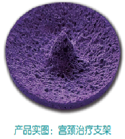 子宫支架怎么上宫颈HPV感染者的福音——宫颈治疗支架疗法，你知多少？（文末获取5分钟速查方式）_https://www.jmylbn.com_新闻资讯_第9张