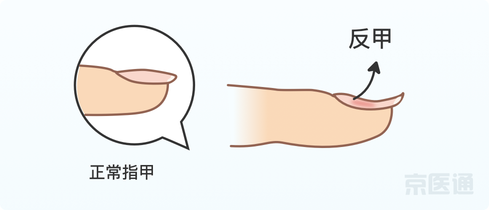 指甲上沒月牙、有橫線、長倒刺，是身體出問題了嗎？ 健康 第12張
