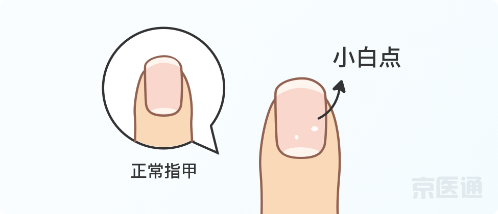 指甲上沒月牙、有橫線、長倒刺，是身體出問題了嗎？ 健康 第7張