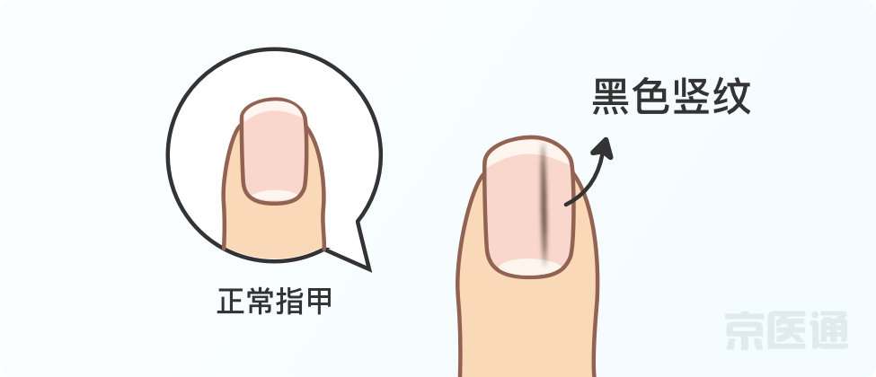 指甲上沒月牙、有橫線、長倒刺，是身體出問題了嗎？ 健康 第13張