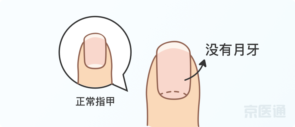 指甲上沒月牙、有橫線、長倒刺，是身體出問題了嗎？ 健康 第5張