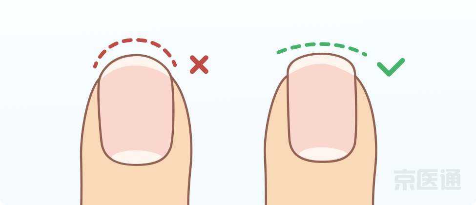 指甲上沒月牙、有橫線、長倒刺，是身體出問題了嗎？ 健康 第14張