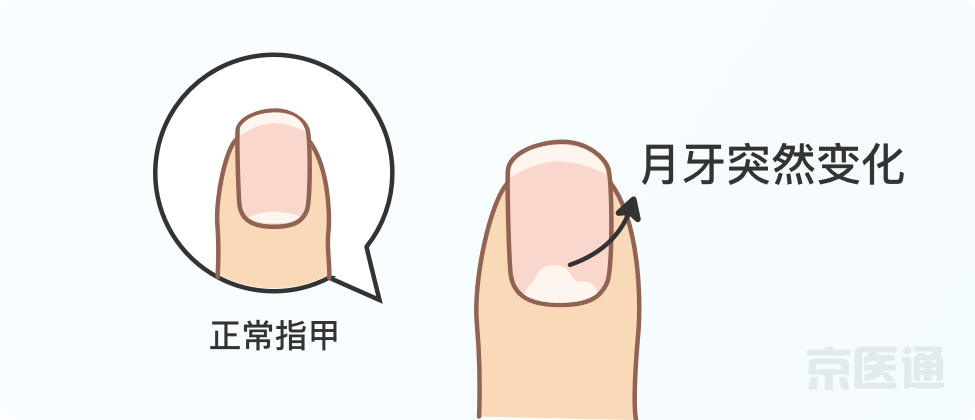 指甲上沒月牙、有橫線、長倒刺，是身體出問題了嗎？ 健康 第9張
