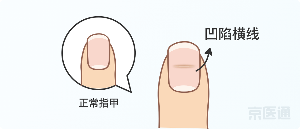指甲上沒月牙、有橫線、長倒刺，是身體出問題了嗎？ 健康 第10張