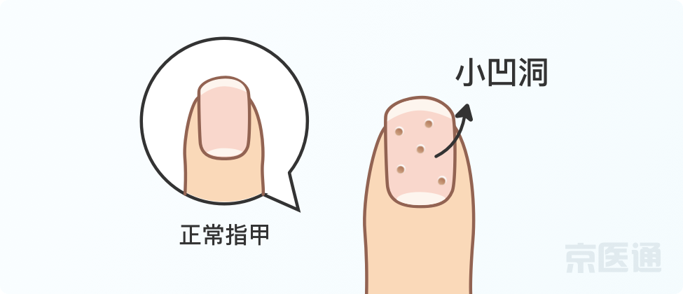 指甲上沒月牙、有橫線、長倒刺，是身體出問題了嗎？ 健康 第11張