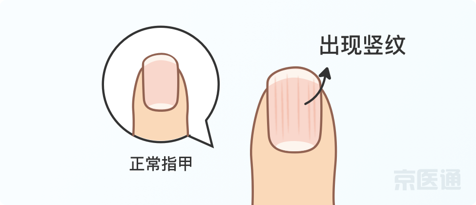 指甲上沒月牙、有橫線、長倒刺，是身體出問題了嗎？ 健康 第6張