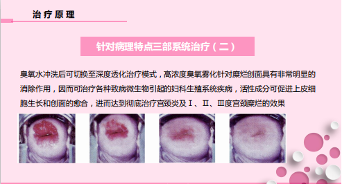 怎么销售透化治疗系统守护女性健康——SLOT妇科深度透化治疗系统_https://www.jmylbn.com_新闻资讯_第7张