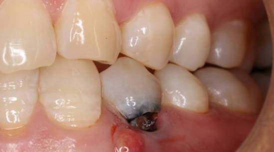 根尖片:44根尖及近中根周阴影. 诊断:44慢性根尖周炎伴瘘管.