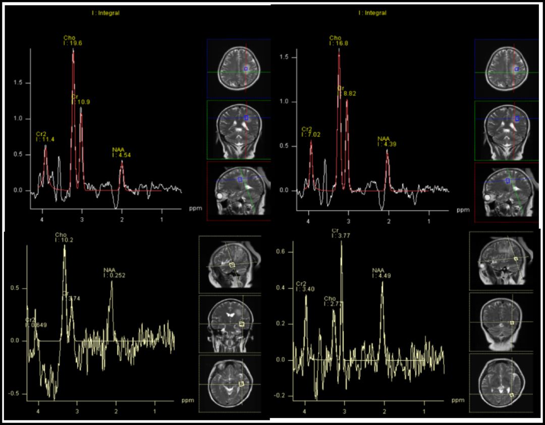 考虑患者颅内为多发病灶,且左侧颞岛病灶含有钙化成分,进一步行磁共振
