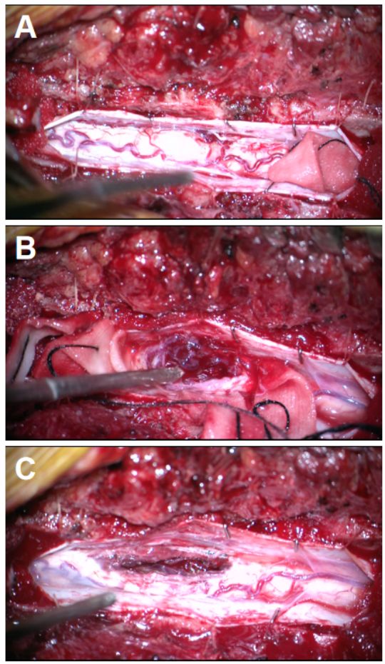 術中採用銑刀銑下胸9-11椎板及棘突,切開硬脊膜及蛛網膜,見脊髓腫脹