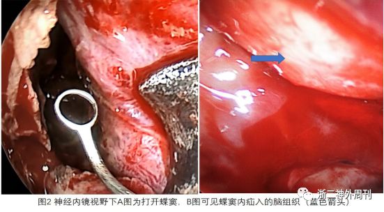 sternberg管未閉腦膜腦膨出致腦脊液鼻漏一例浙二神外週刊第128期