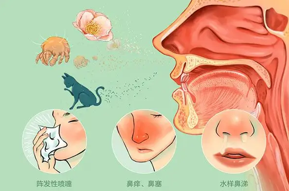 鼻腔喷雾器有什么作用【科普知识】鼻炎患者如何选择海水鼻腔喷雾器_https://www.jmylbn.com_新闻资讯_第17张