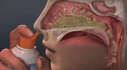 鼻腔喷雾器有什么作用【科普知识】鼻炎患者如何选择海水鼻腔喷雾器_https://www.jmylbn.com_新闻资讯_第15张