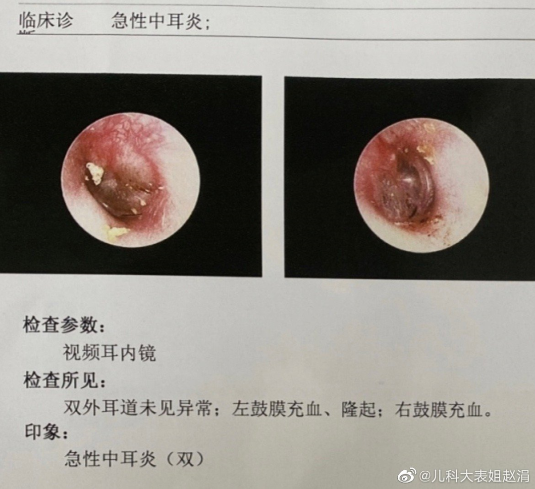 什么是中耳筛查孩子感冒后耳痛，是怎么回事？你见过中耳炎导致的鼓膜充血和膨出吗？中耳炎服用阿莫西林克拉维酸钾需要注意什么？-上海聚慕医疗器械有限公司