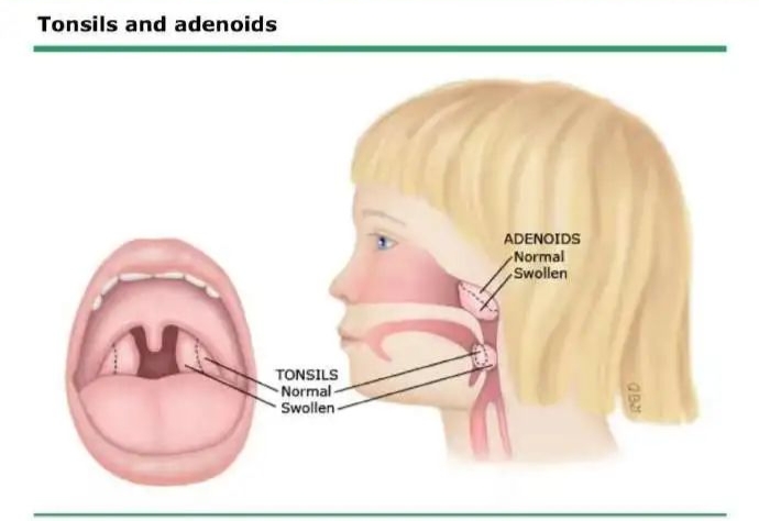 外科胶带怎么撕暑假到了，耳鼻喉科和泌尿外科又要掀起一轮手术狂潮！腺样体／扁桃体切除手术，你家孩子真的需要做吗？_https://www.jmylbn.com_新闻资讯_第6张