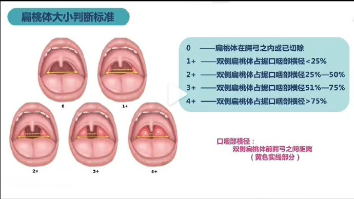 外科胶带怎么撕暑假到了，耳鼻喉科和泌尿外科又要掀起一轮手术狂潮！腺样体／扁桃体切除手术，你家孩子真的需要做吗？_https://www.jmylbn.com_新闻资讯_第32张