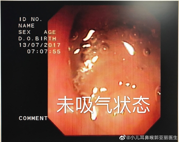 外科胶带怎么撕暑假到了，耳鼻喉科和泌尿外科又要掀起一轮手术狂潮！腺样体／扁桃体切除手术，你家孩子真的需要做吗？_https://www.jmylbn.com_新闻资讯_第15张