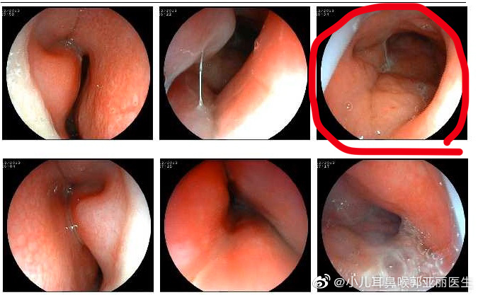 外科胶带怎么撕暑假到了，耳鼻喉科和泌尿外科又要掀起一轮手术狂潮！腺样体／扁桃体切除手术，你家孩子真的需要做吗？_https://www.jmylbn.com_新闻资讯_第14张