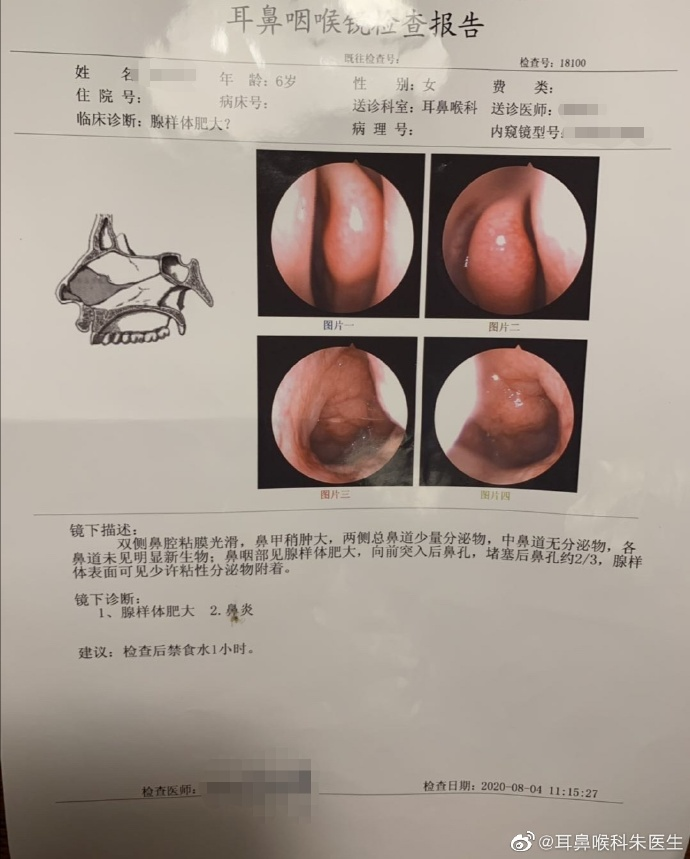 外科胶带怎么撕暑假到了，耳鼻喉科和泌尿外科又要掀起一轮手术狂潮！腺样体／扁桃体切除手术，你家孩子真的需要做吗？_https://www.jmylbn.com_新闻资讯_第19张