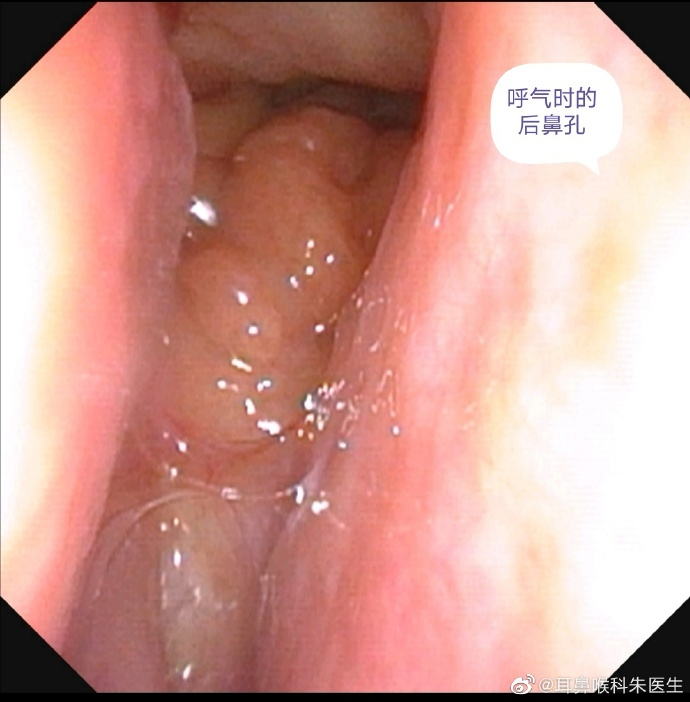 外科胶带怎么撕暑假到了，耳鼻喉科和泌尿外科又要掀起一轮手术狂潮！腺样体／扁桃体切除手术，你家孩子真的需要做吗？_https://www.jmylbn.com_新闻资讯_第18张
