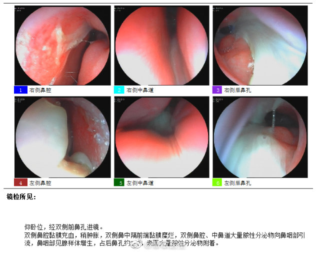 外科胶带怎么撕暑假到了，耳鼻喉科和泌尿外科又要掀起一轮手术狂潮！腺样体／扁桃体切除手术，你家孩子真的需要做吗？_https://www.jmylbn.com_新闻资讯_第11张