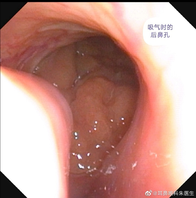 外科胶带怎么撕暑假到了，耳鼻喉科和泌尿外科又要掀起一轮手术狂潮！腺样体／扁桃体切除手术，你家孩子真的需要做吗？_https://www.jmylbn.com_新闻资讯_第17张