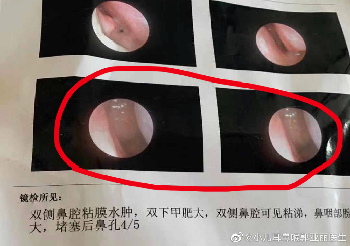 外科胶带怎么撕暑假到了，耳鼻喉科和泌尿外科又要掀起一轮手术狂潮！腺样体／扁桃体切除手术，你家孩子真的需要做吗？_https://www.jmylbn.com_新闻资讯_第13张