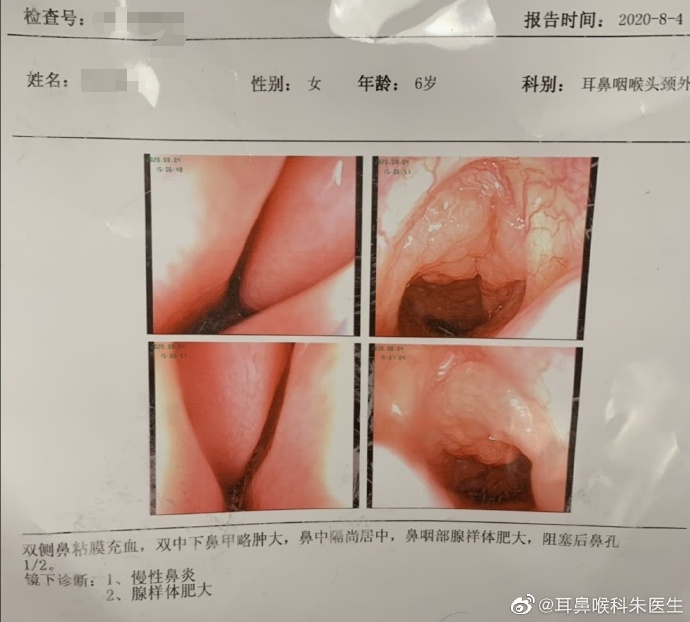 外科胶带怎么撕暑假到了，耳鼻喉科和泌尿外科又要掀起一轮手术狂潮！腺样体／扁桃体切除手术，你家孩子真的需要做吗？_https://www.jmylbn.com_新闻资讯_第20张