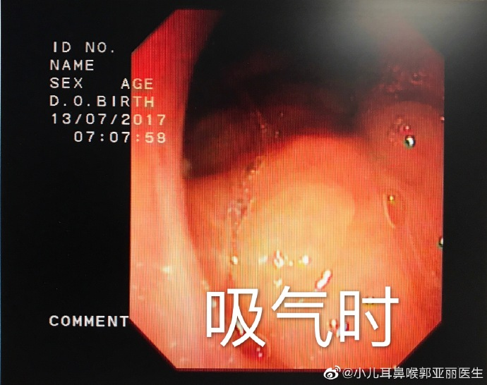 外科胶带怎么撕暑假到了，耳鼻喉科和泌尿外科又要掀起一轮手术狂潮！腺样体／扁桃体切除手术，你家孩子真的需要做吗？_https://www.jmylbn.com_新闻资讯_第16张