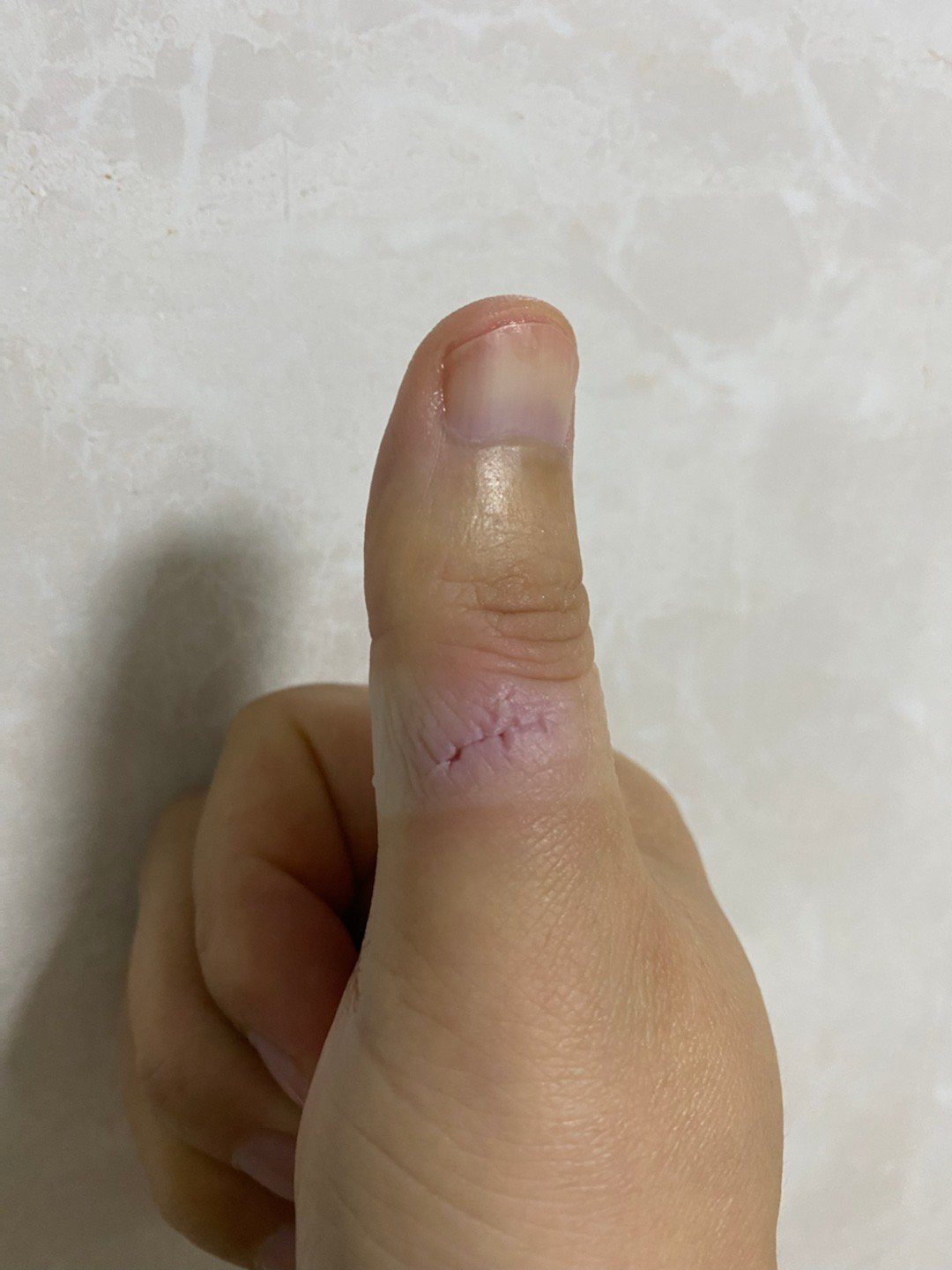 医用凡士林敷料怎么用6岁女童在小区摸了下竹子，手掌被扎了200根刺！孩子的妈妈用各种“偏方”拔刺：醋泡、用瓶子吸、针挑、胶布粘……手掌差点报废_https://www.jmylbn.com_新闻资讯_第14张