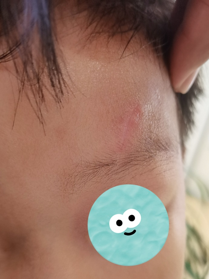 医用凡士林敷料怎么用6岁女童在小区摸了下竹子，手掌被扎了200根刺！孩子的妈妈用各种“偏方”拔刺：醋泡、用瓶子吸、针挑、胶布粘……手掌差点报废_https://www.jmylbn.com_新闻资讯_第38张