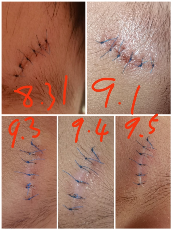 医用凡士林敷料怎么用6岁女童在小区摸了下竹子，手掌被扎了200根刺！孩子的妈妈用各种“偏方”拔刺：醋泡、用瓶子吸、针挑、胶布粘……手掌差点报废_https://www.jmylbn.com_新闻资讯_第43张