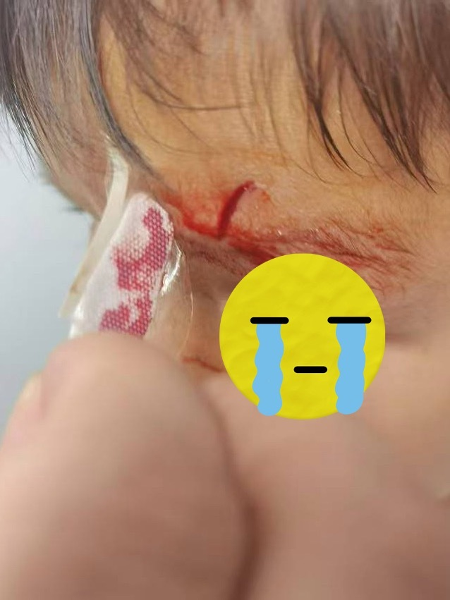 医用凡士林敷料怎么用6岁女童在小区摸了下竹子，手掌被扎了200根刺！孩子的妈妈用各种“偏方”拔刺：醋泡、用瓶子吸、针挑、胶布粘……手掌差点报废_https://www.jmylbn.com_新闻资讯_第37张