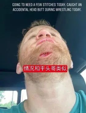 医用凡士林敷料怎么用6岁女童在小区摸了下竹子，手掌被扎了200根刺！孩子的妈妈用各种“偏方”拔刺：醋泡、用瓶子吸、针挑、胶布粘……手掌差点报废_https://www.jmylbn.com_新闻资讯_第26张