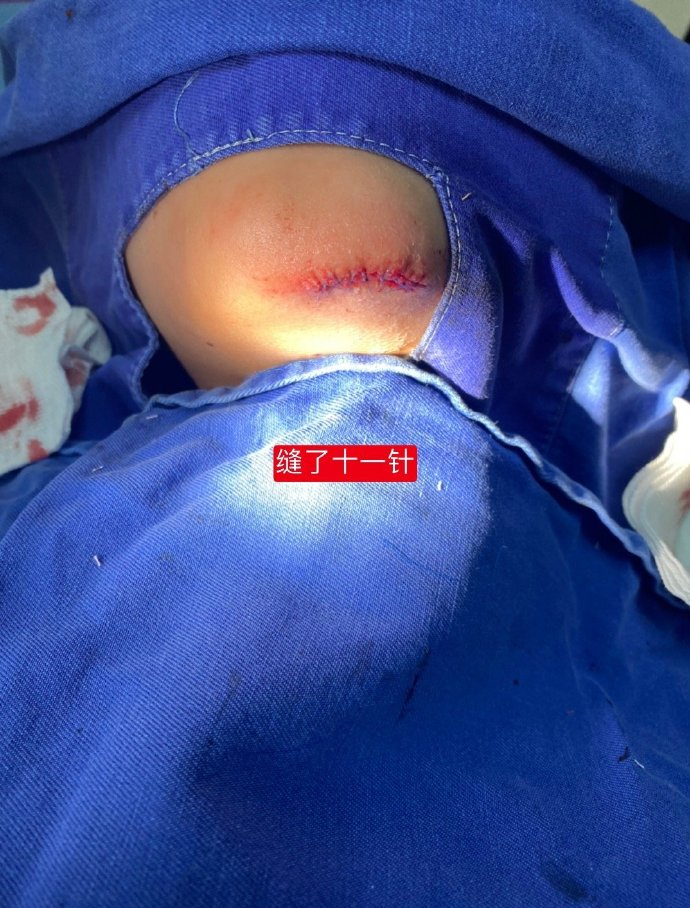 医用凡士林敷料怎么用6岁女童在小区摸了下竹子，手掌被扎了200根刺！孩子的妈妈用各种“偏方”拔刺：醋泡、用瓶子吸、针挑、胶布粘……手掌差点报废_https://www.jmylbn.com_新闻资讯_第25张