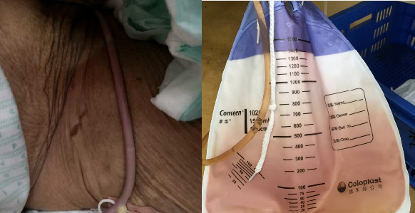 导尿袋什么导尿袋的尿液突变紫色，一查竟然是……_https://www.jmylbn.com_新闻资讯_第3张