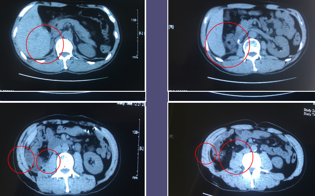 肾癌复发转移不可怕精准治疗方案很重要