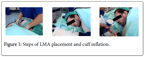 喉罩装置有哪些俯卧位喉罩通气，是炫技还是硬核技术？_https://www.jmylbn.com_新闻资讯_第9张